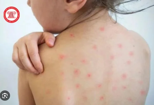 Chăm sóc trẻ đúng cách khi bị bệnh sởi